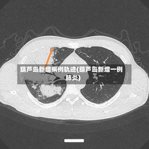 葫芦岛新增病例轨迹(葫芦岛新增一例肺炎)