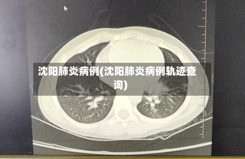 沈阳肺炎病例(沈阳肺炎病例轨迹查询)-第2张图片