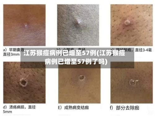 江苏猴痘病例已增至57例(江苏猴痘病例已增至57例了吗)-第3张图片